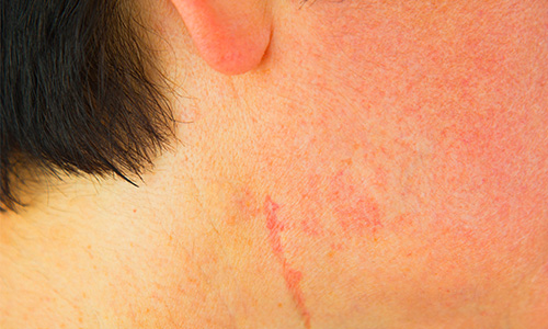 治疗疤痕组织的药物：对皮肤有着不可忽视的疗效